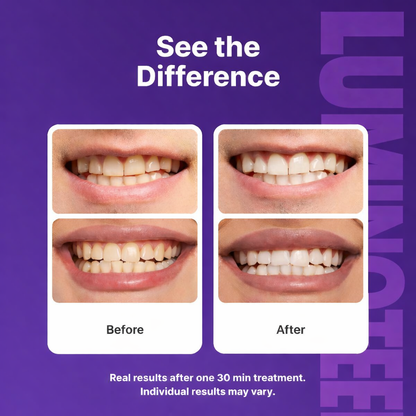 Purple Whitening Strips