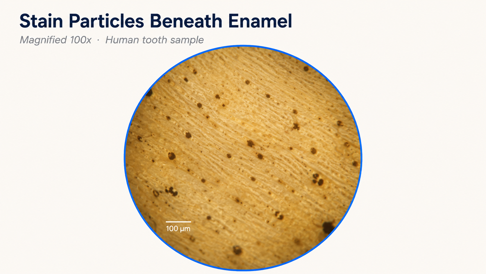 Stain particles beneath enamel